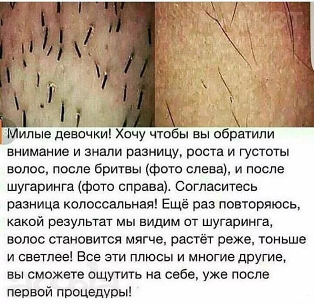 Сахарная депиляция (шугаринг)